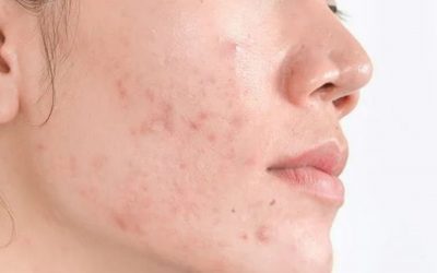 Taches pigmentaires post-inflammatoires (PIH) :