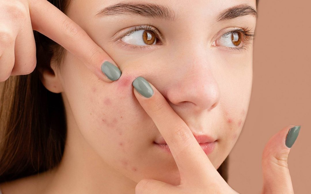 Pourquoi l&rsquo;acné revient toujours au même endroit ?