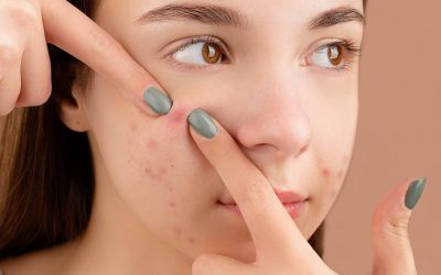 Pourquoi l’acné revient toujours au même endroit ?