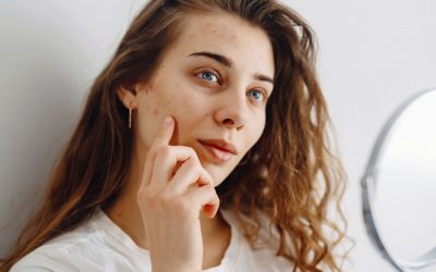 L’acné chez les adultes : un phénomène en hausse ?