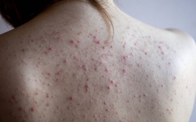 Acné du dos : pourquoi ses causes sont difficiles à identifier ?