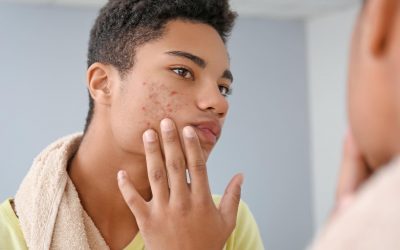 Acné après-rasage : les erreurs que les hommes doivent éviter