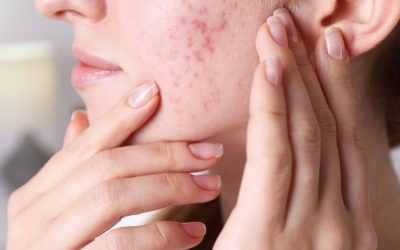 Qu’est-ce que l’acné hormonale et comment la reconnaître ?