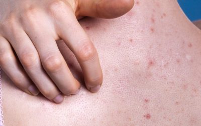 Acné du visage vs acné du corps : quelles différences ?