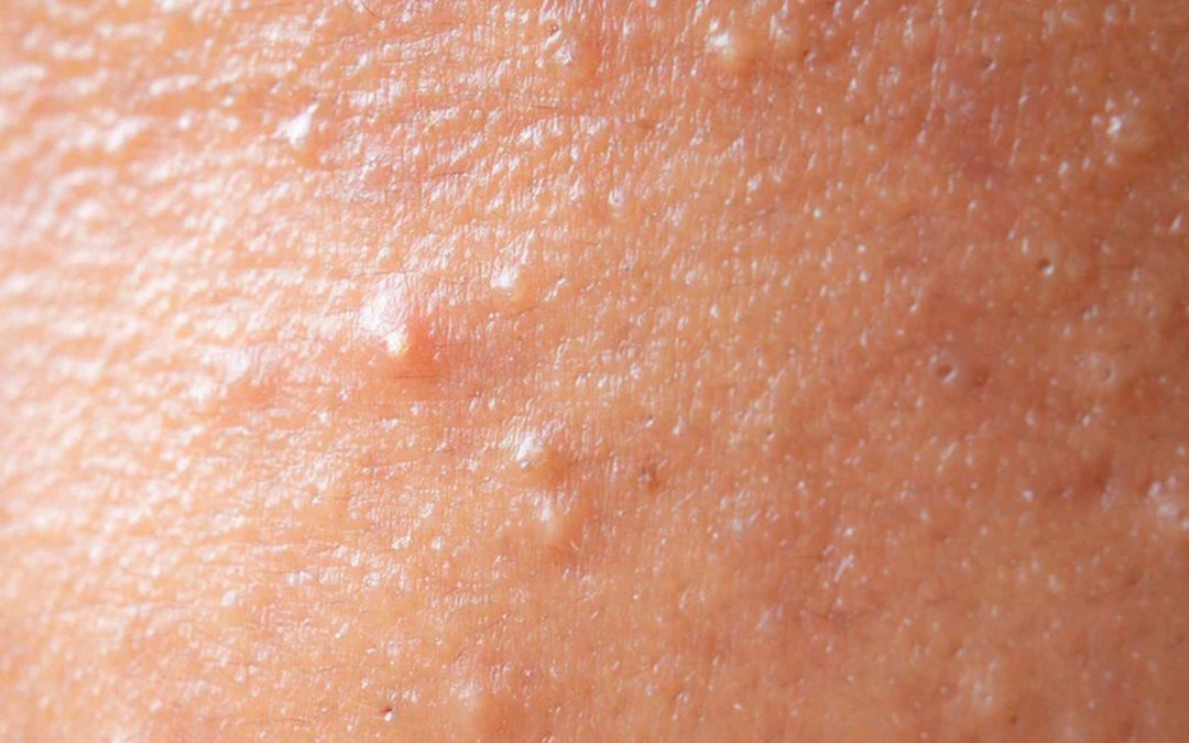 Acné hormonale vs. acné fongique : comment savoir ce que vous avez ?