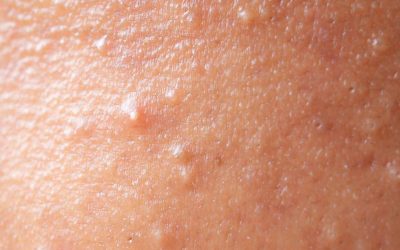 Acné hormonale vs. acné fongique : comment savoir ce que vous avez ?