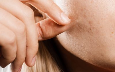 Acné kystique : pourquoi est-elle plus fréquente chez certains ?