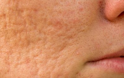 Cicatrices d’acné : comment évoluent-elles avec le temps ?