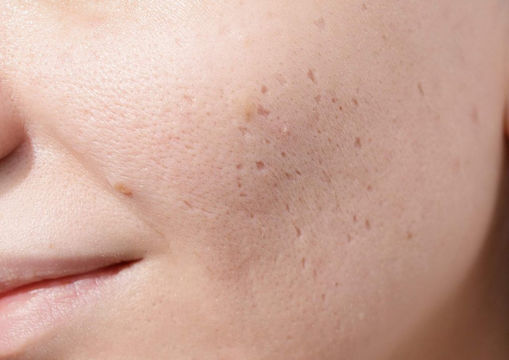 cicatrices_d'acne