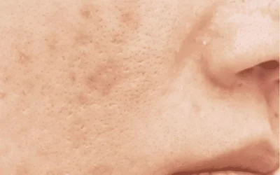 Cicatrices d’acné rouges, brunes, violettes : comprendre les différences de couleur