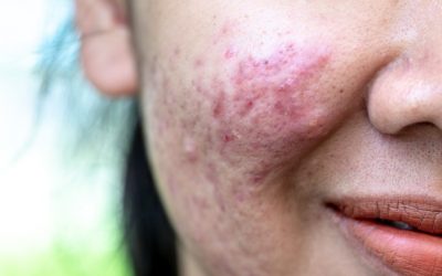 Cicatrices hypertrophiques et chéloïdes : causes et solutions