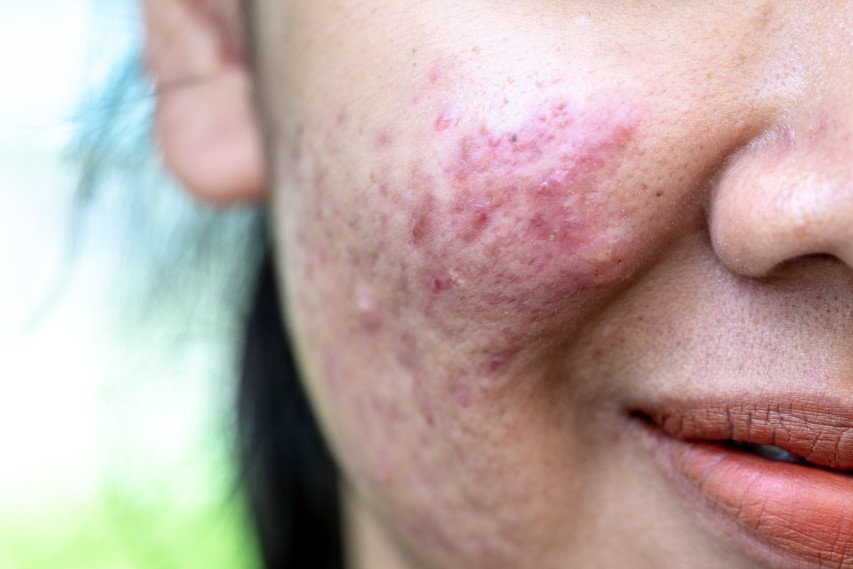 Cicatrices hypertrophiques et chéloïdes : causes et solutions