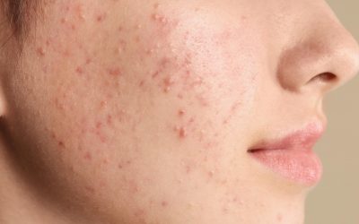 Les statistiques mondiales sur l’acné kystique