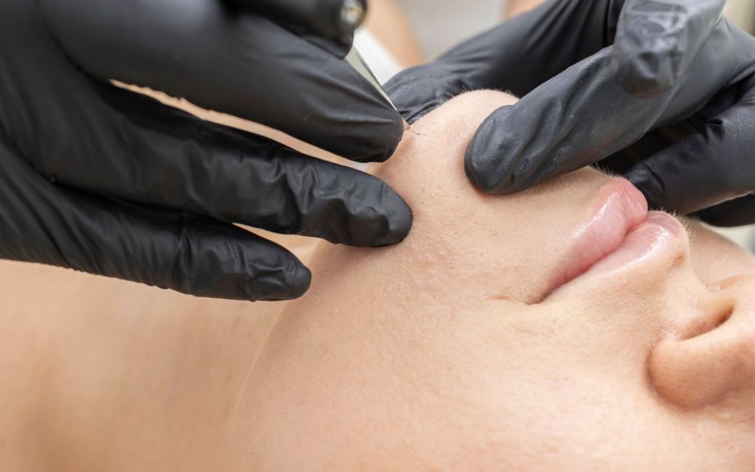 Mon esthéticienne peut-elle extraire mes microkystes ?