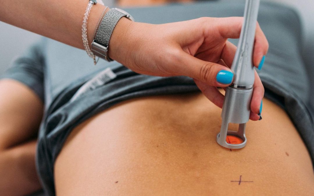 Le laser pour traiter l’acné corporelle : ce qu’il faut savoir