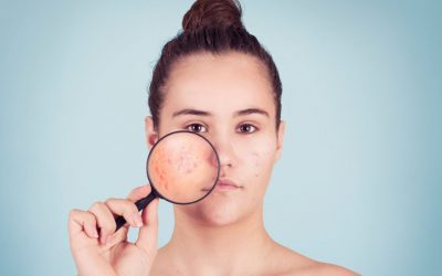 Les types d’acné les plus méconnus