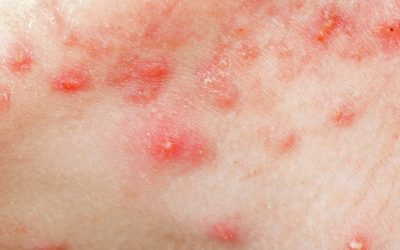 Les pires conseils beauté pour l’acné