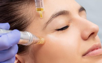 ZOOM sur Le microneedling contre l’acné