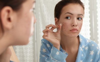 Acné kystique vs autres types d’acné : quelles différences ?
