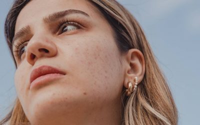 Qu’est-ce que l’acné kystique et comment la reconnaître ?