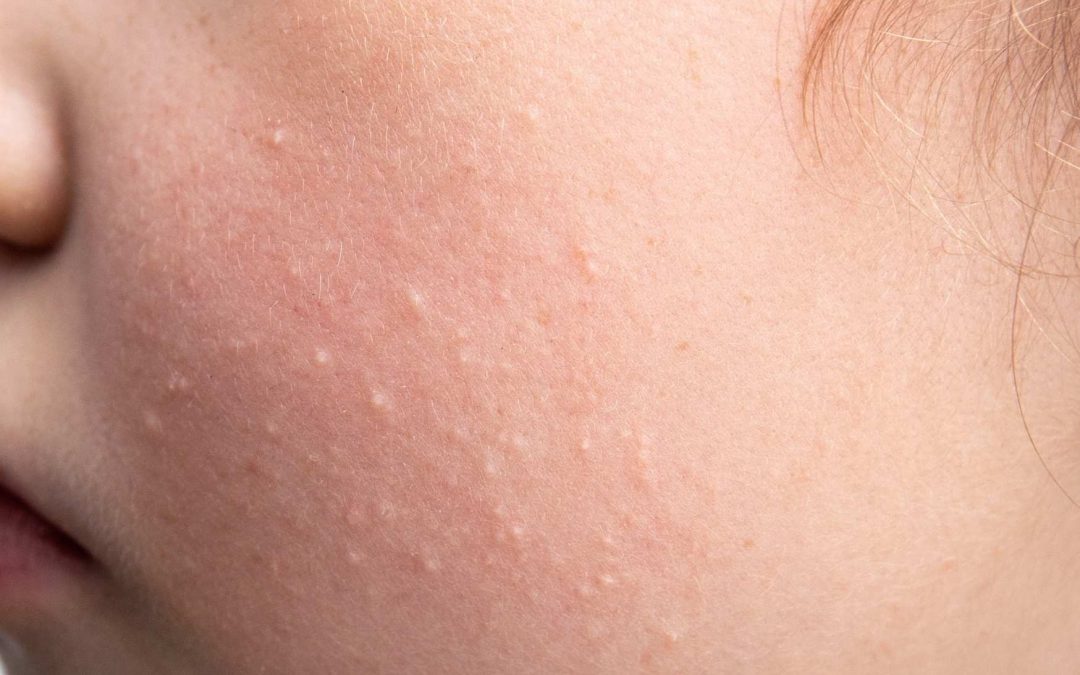 Les microkystes : comment se forment-ils ?