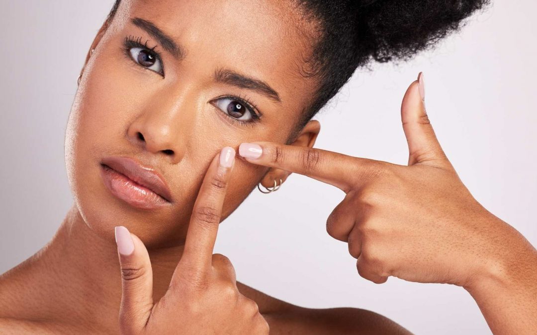 Points noirs : une question d’hygiène ou de génétique ?