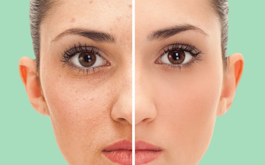 Comment supprimer facilement votre acné sur les photos