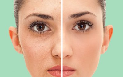 Comment supprimer facilement votre acné sur les photos