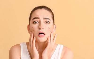 Pourquoi les traitements contre l’acné échouent